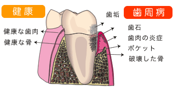 歯周病イラスト