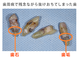 歯周病で抜け落ちた歯